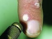 Como quitar verrugas