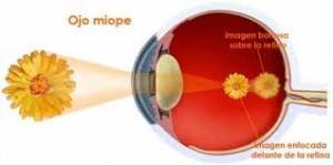 Por qué se produce Miopía