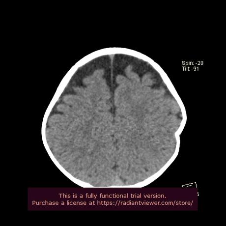 TRAUMATISMO CRANEOENCEFÁLICO CON FRACTURA HUNDIMIENTO