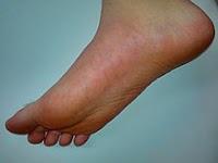 La fibrilación auricular se puede diagnosticar en los pies de los Diabeticos La fibrilación auricular se puede diagnosticar en los pies de los Diabeticos