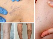 Remedios caseros para varices. Cómo eliminar varices forma natural