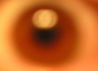 Paciente de 58 años con visión doble diagnosticado con COVID-19. Paciente de 58 años con visión doble diagnosticado con COVID-19.