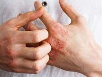 El baricitinib es eficaz en pacientes con dermatitis atópica