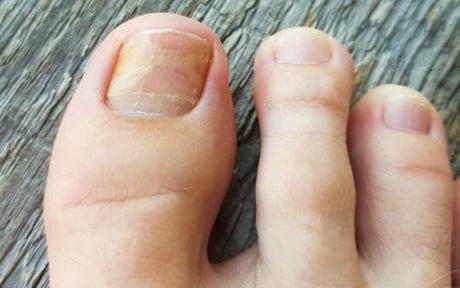 onicomicosis tratamiento