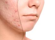 Remedios caseros para acné