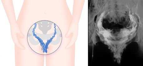 Expertos avisan de que las varices genitales alteran en gran medida la calidad de vida de las pacientes Expertos avisan de que las varices genitales alteran en gran medida la calidad de vida de las pacientes