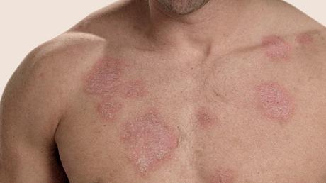 Nueva terapia experimental utiliza anticuerpos contra el lupus