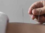 beneficios acupuntura para salud