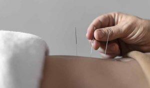 6 beneficios de la acupuntura para la salud - Trucos de salud caseros