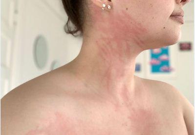 Conozca el extraño caso de una joven estadounidense que sufre de Urticaria Acuagénica