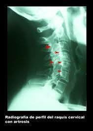 ¿Qué es la Artrosis Cervical o Cervicartrosis?