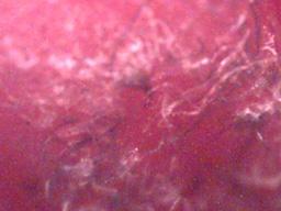 Morgellons: ¿nanotecnología intrusa en nuestro cuerpo?