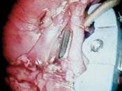 Novedoso Método para realizar Anastomosis Vasculares