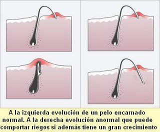 Esa tremenda maldición...¿tiene solución? pelos encarnados, enquistados