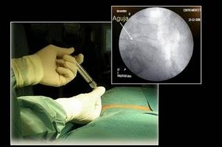 Una terapia experimental para tratar la lumbalgia