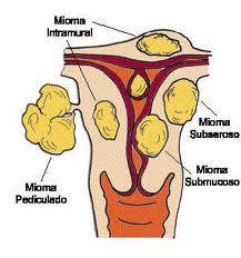 La relación miomas y embarazo