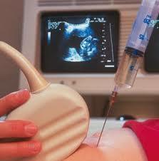 Como se realiza la amniocentesis durante el embarazo