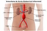 Experiencia quirúrgica aneurismas aórticos infrarrenales infectados