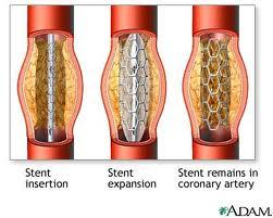 Colocación de stent en la carótida