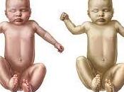 Validación estrategia para evaluar riesgo hiperbilirrubinemia significativa