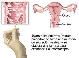 Impacto de la gravedad de la vaginosis bacteriana