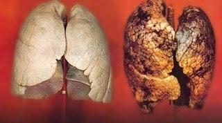 El cáncer  pulmonar de células no pequeñas: Nuevo tratamiento de diagnostico y terapéutico