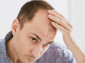 técnicas trasplante capilar doctor Bruno Jacobovski