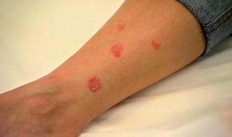 Síntomas y causas de tener alergias en la piel