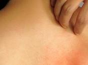 Síntomas causas tener alergias piel