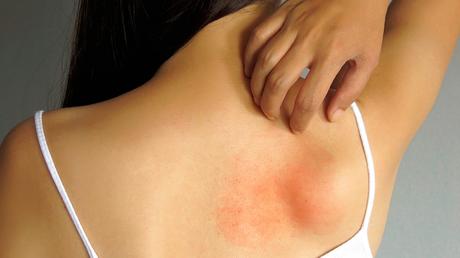 Síntomas y causas de tener alergias en la piel