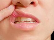 Llagas boca: remedios caseros para tratar esta dolencia