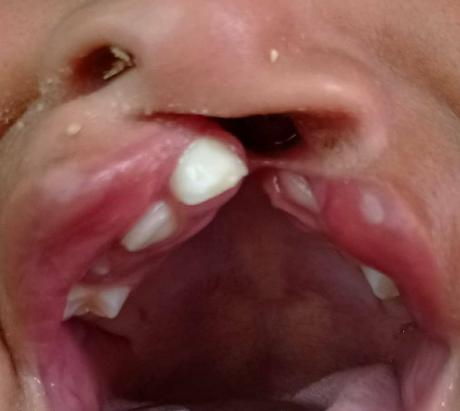 Falta de control prenatal y alimentación adecuada eleva estadísticas de labio y paladar hendido en Nueva Esparta