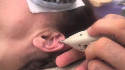 Auriculoterapia. Qué es. Mapa y puntos. Sus usos para adelgazar, ciática, dejar de fumar, ansiedad y el insomnio 4 auriculoterapia mapa