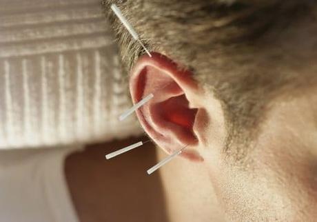 Auriculoterapia. Qué es. Mapa y puntos. Sus usos para adelgazar, ciática, dejar de fumar, ansiedad y el insomnio 5 auriculoterapia adelgazar