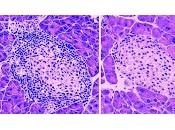 Proteina puede Frenar Aparicion Diabetes tipo