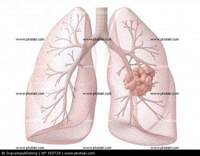 Vacuna para el cáncer de pulmon.
