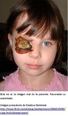 Testimonio - Ojo vago - Harta de usar parche