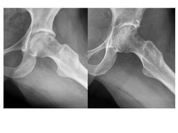 Choque femoro acetabular