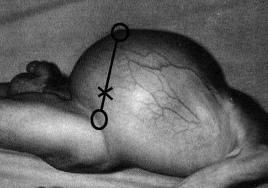 Paciente de 43 años con ascitis, ¿cómo estudiarlo?