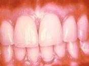 Diabetes infección periodontal