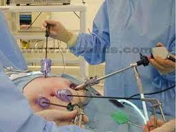 Tratamiento para la recuperación de cálculos en el colédoco durante la colecistectomía laparoscópica