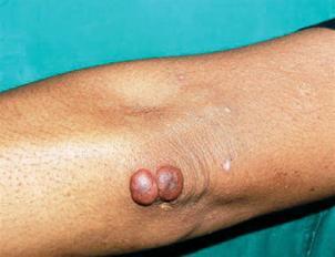 Eritema elevatum diutinum extenso ampollar y erosivo en un paciente con HIV