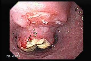 El cáncer pulmonar de células no pequeñas: Un nuevo enfoque diagnóstico y terapéutico