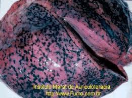 El cáncer pulmonar de células no pequeñas: Un nuevo enfoque diagnóstico y terapéutico