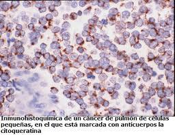 El cáncer pulmonar de células no pequeñas: Un nuevo enfoque diagnóstico y terapéutico