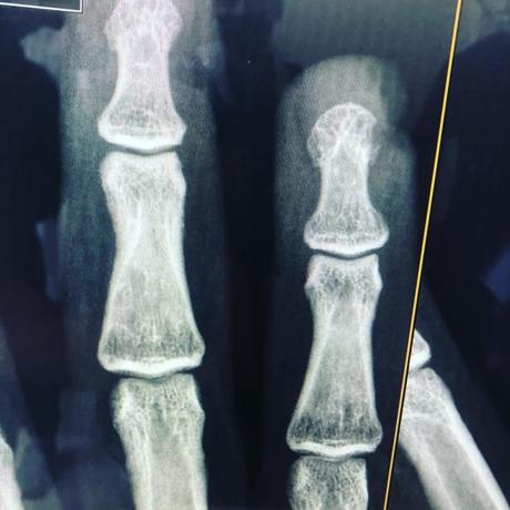 Fractura expuesta de falange