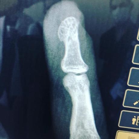 Fractura expuesta de falange