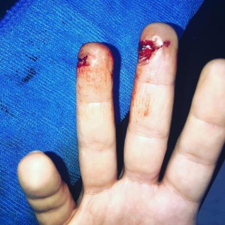 Fractura expuesta de falange