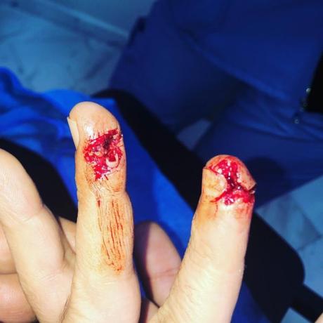 Fractura expuesta de falange