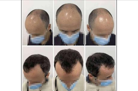 Tratamiento de mesoterapia capilar del Dr. Bruno Jacobovski Tratamiento de mesoterapia capilar del Dr. Bruno Jacobovski
